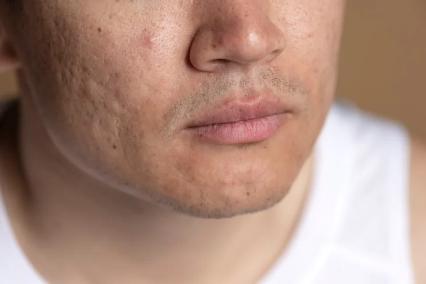 How Acne Scar Treatments Address Deep Scars?