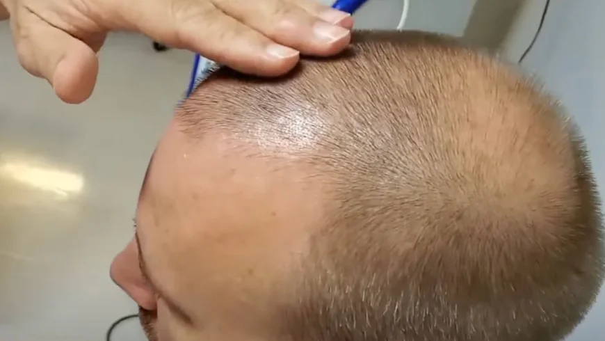 Stem Cell Therapy for Hair Loss: Does It Work?