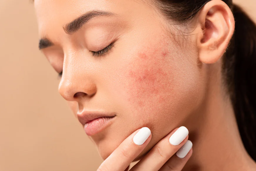 Acne Treatment for Sensitive Skin: Safe and Proven Methods