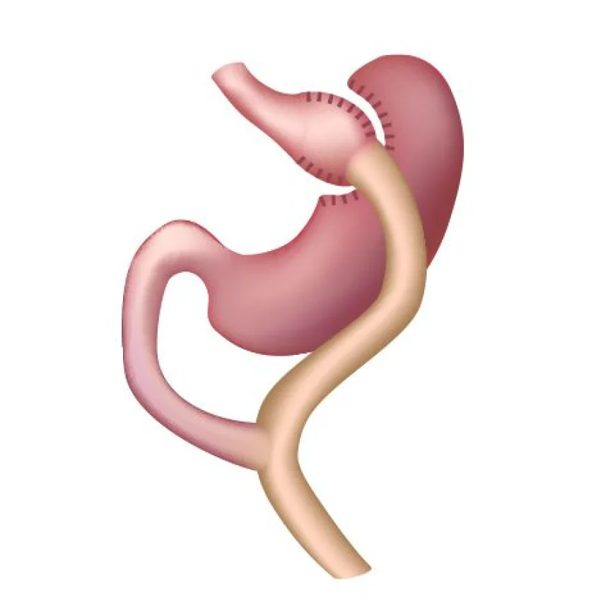 How Does Gastric Bypass Surgery Work?