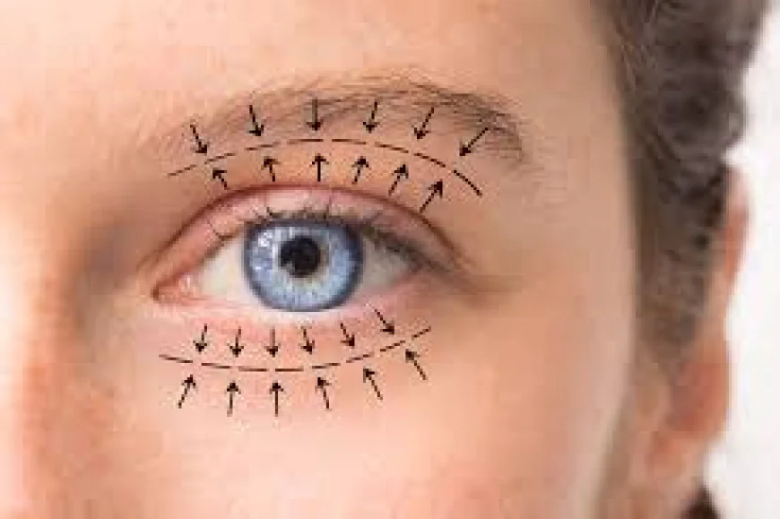 Why Is Blepharoplasty Trending Now?