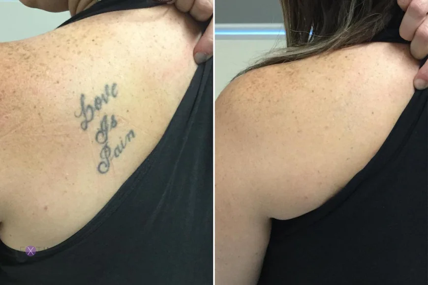 Tattoo Removal for Colored Ink: What Works Best?
