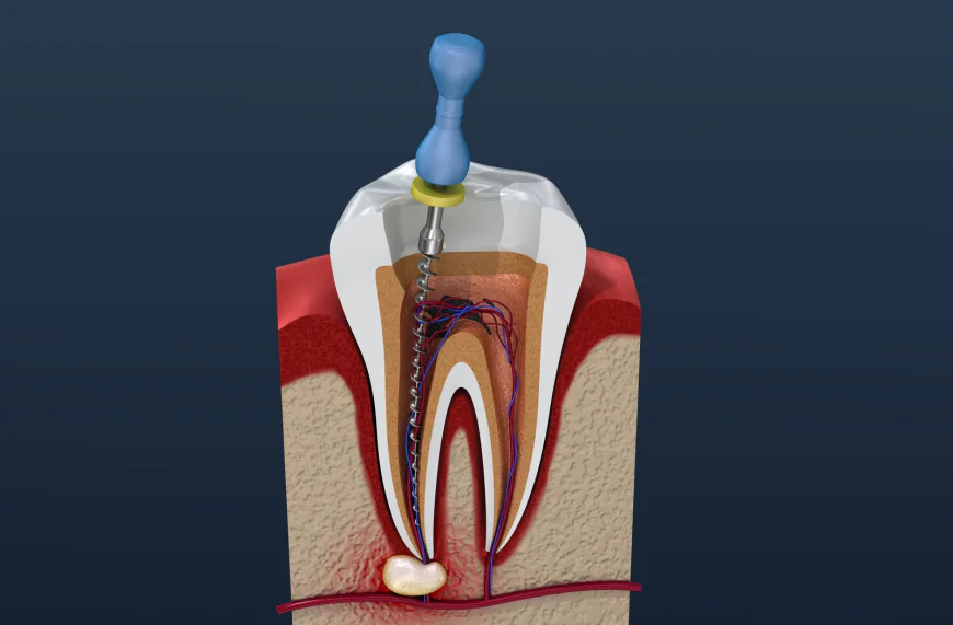 How Technology Affects Root Canal Treatment Cost and Results