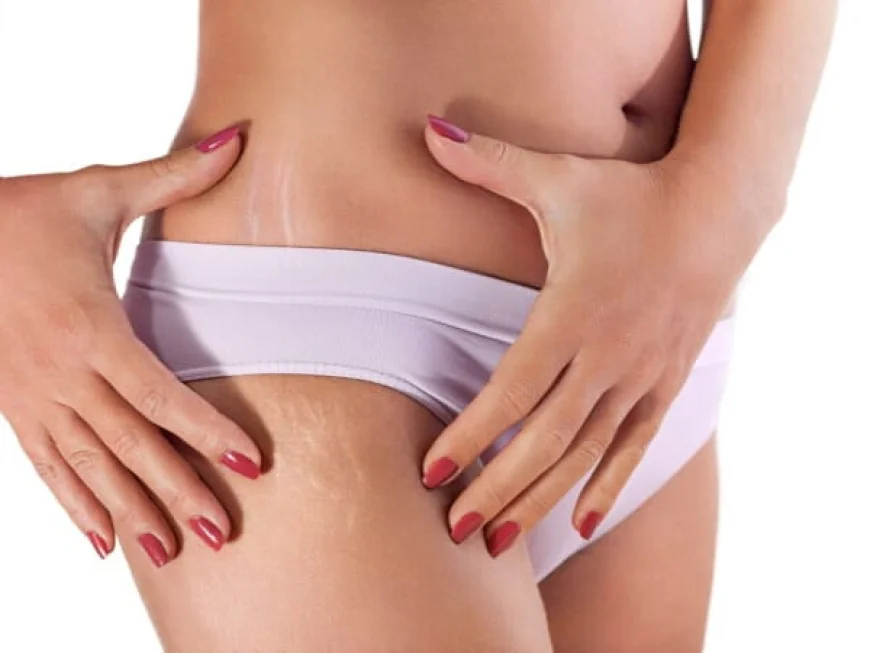 What Skin Types Use Stretch Marks Laser Removal?