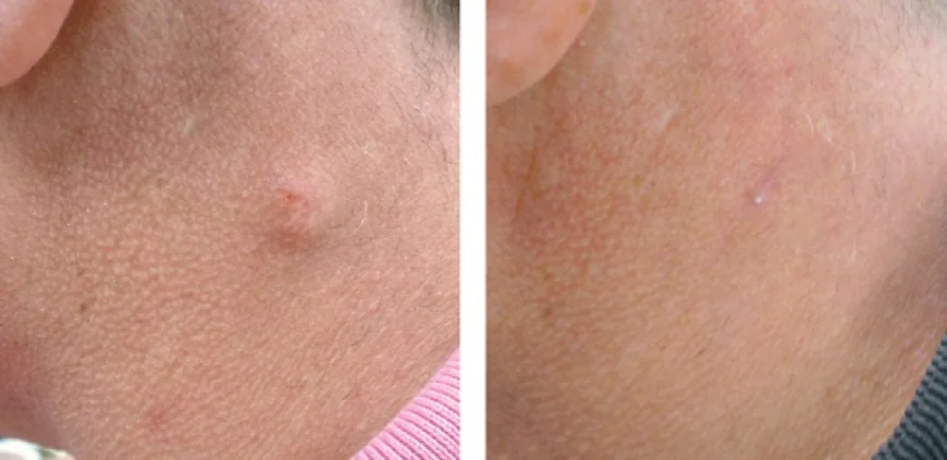 Affordable Cyst Removal Near Me: A Complete Patient Guide