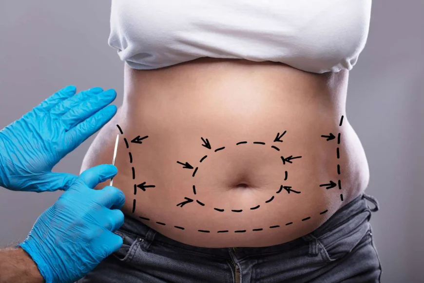 Tummy Tuck in Dubai: Restoring Core Function and Form