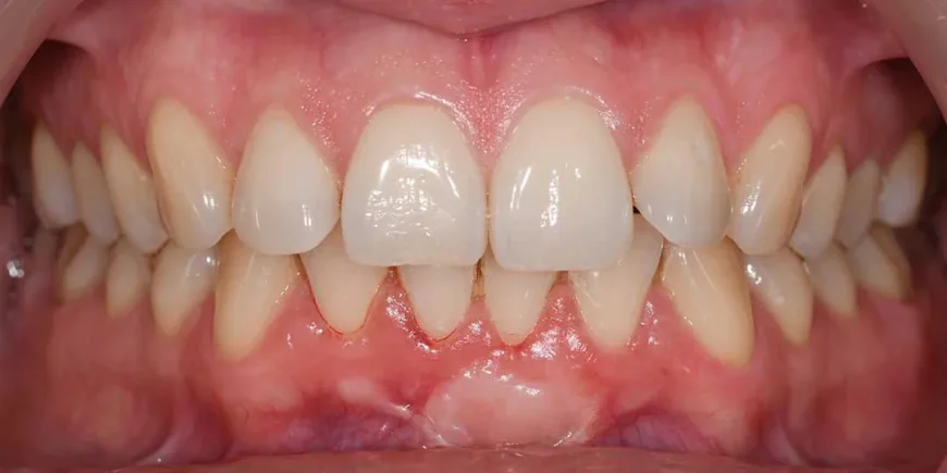 How Can Gum Recession Be Treated Effectively?