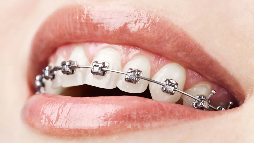 Dental Braces in Dubai: Complete Smile Guide