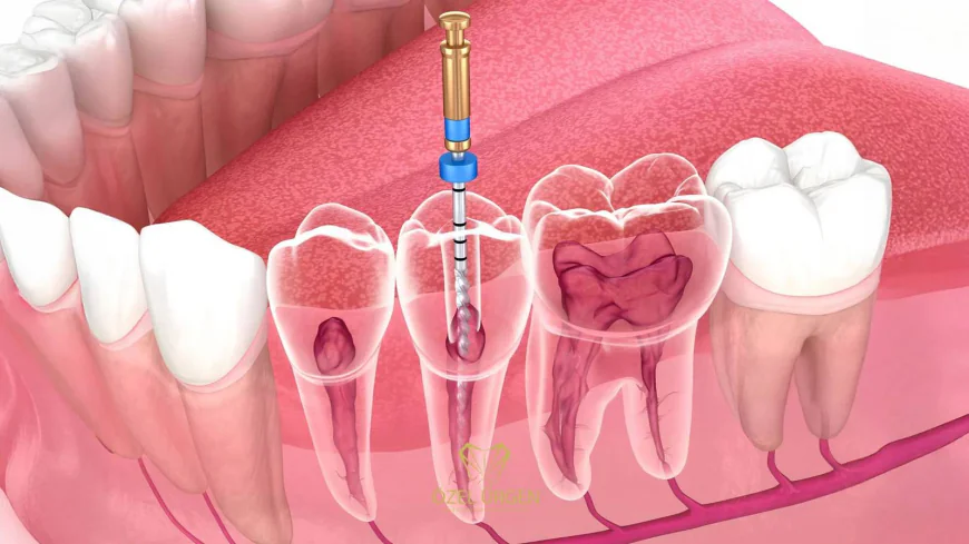 Root Canal Treatment in Dubai: Step-by-Step Procedure
