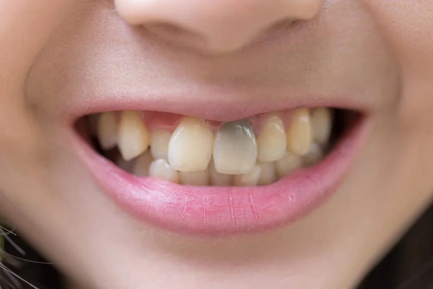 Can a Dentist Fix a Black Tooth? Causes and Treatment Options