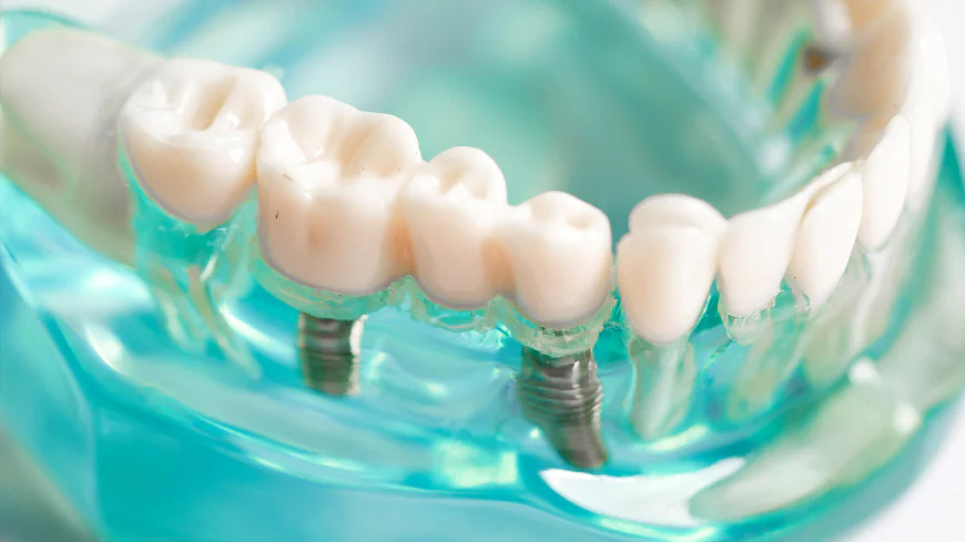 Dental Implant Cost In Dubai: What Affects Pricing