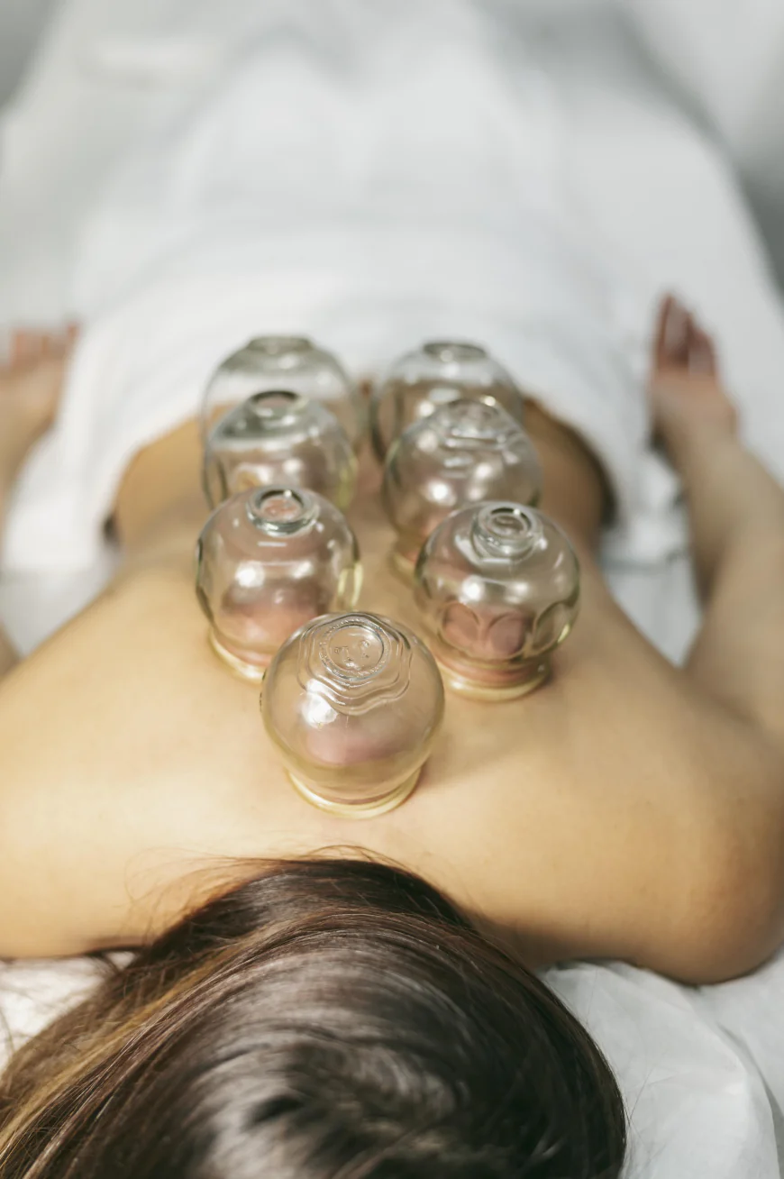 Cupping Therapy Treatment for Sports Injuries and Recovery: A Complete Guide