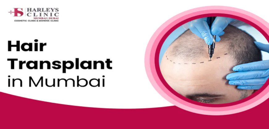How to Plan the Expenses for Hair Transplant Surgery