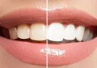 Professional Teeth Whitening Dubai Clinic Tips