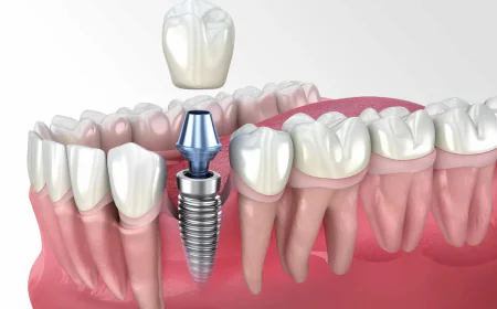 Affordable Dental Crown Options for Restoring Your Smile