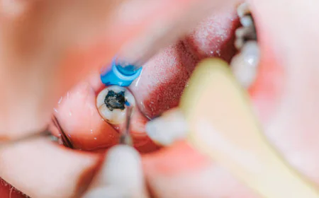 Dental Filling in Pakistan – Restore Your Smile with Modern Dentistry