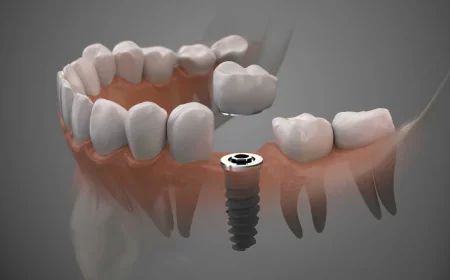 Dental Implant Cost In Dubai: Full Price Guide