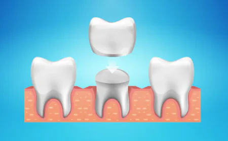 When Do You Really Need Dental Crowns in Simi Valley?