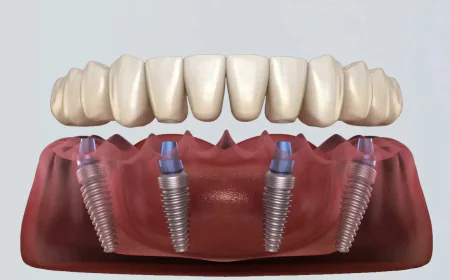 How Long Does All-on-4 Dental Implant Treatment Take?