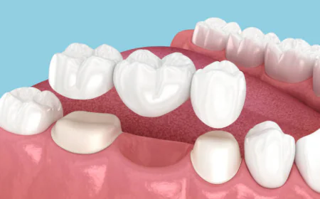 Complete Guide to Restoring Your Smile with Dental Crowns