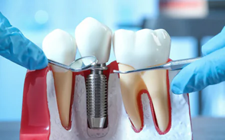 Best Dental Implant Specialist: What Patients Should Look For