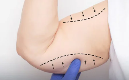 Who Is an Ideal Candidate for Arm Lift Surgery?