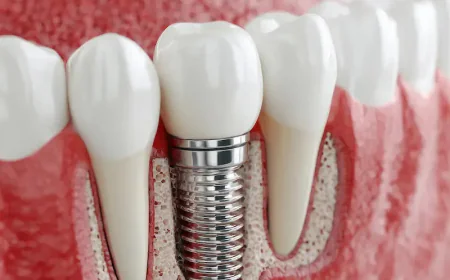 Same-Day Tooth Replacement: Is It Safe and Effective?