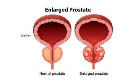 Prostate Enlargement Treatment in Gurgaon