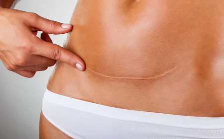 Why Is Mini Abdominoplasty Trending?