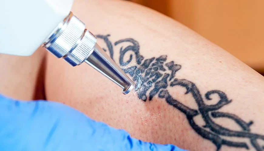 How Tattoo Removal Interacts With Skin Cells