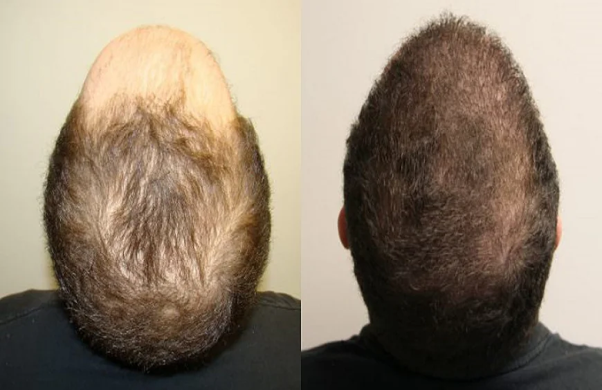 Hair Transplant in Dubai: The Science of Follicular Growth
