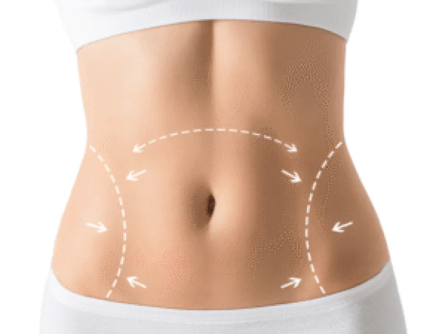 Liposuction in Dubai: Advanced Body Contouring Technology