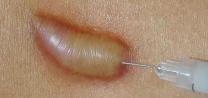 How Keloid Treatment Supports Long-Term Skin Health Goals