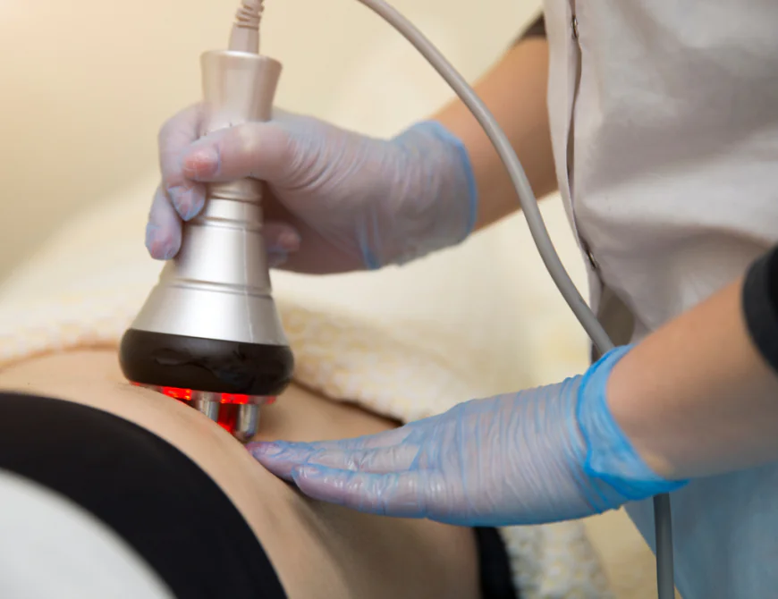 How Cellulite Treatment Relates to Fat Layers