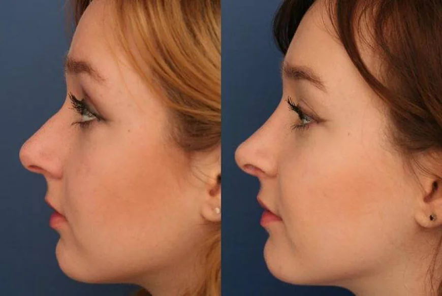 The Science of Symmetry: Precision Rhinoplasty in Riyadh