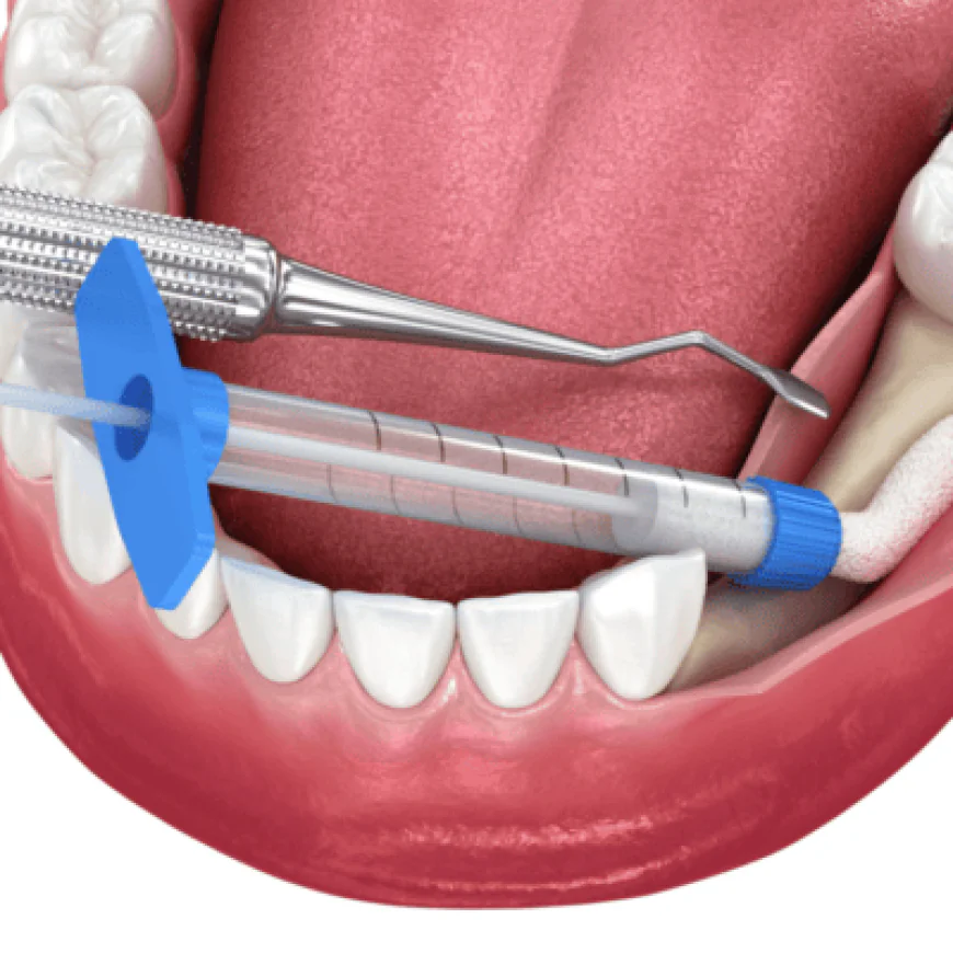 Advanced Periodontal Care: Gum Grafting in Islamabad at Enfeild Royal Clinic