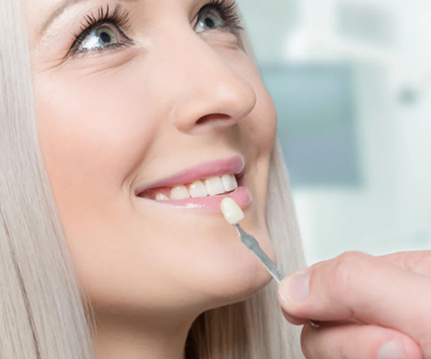 Can Composite Veneers Fix Chipped Teeth?