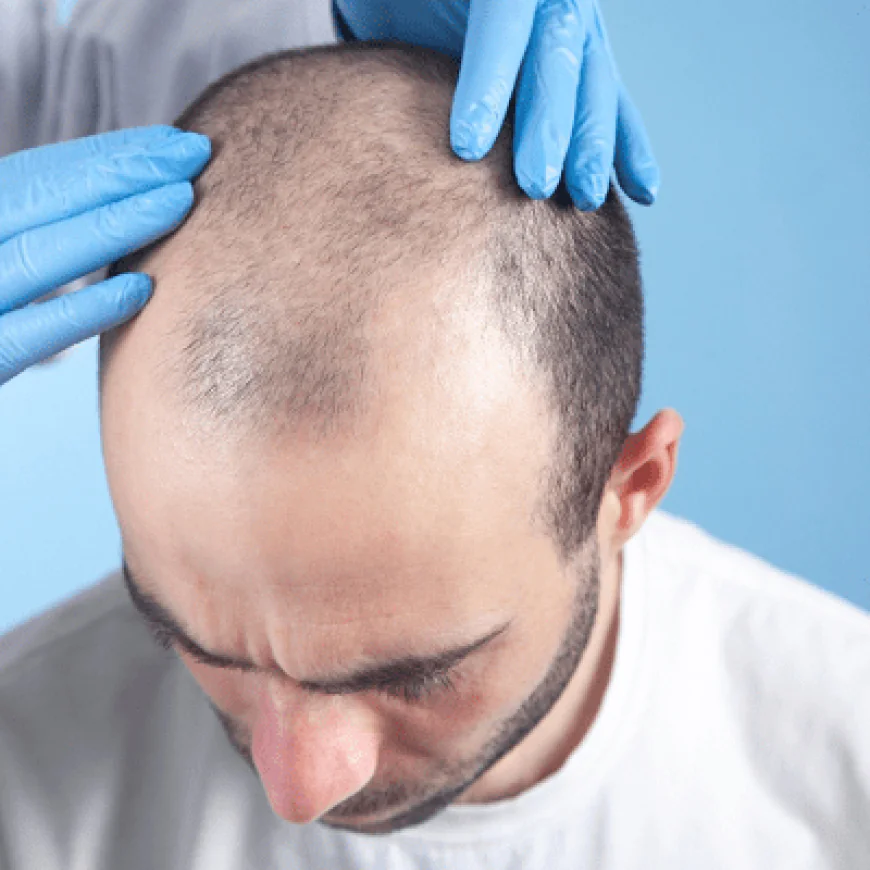 Who Is a Good Candidate for a Hair Transplant?