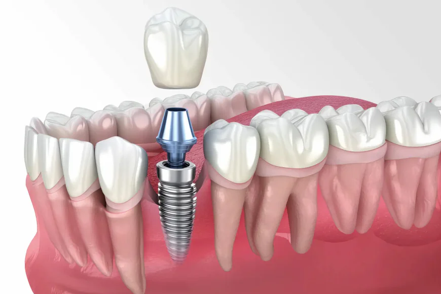 Affordable Dental Crown Options for Restoring Your Smile