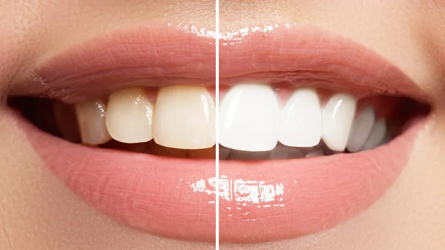 Professional Teeth Whitening Dubai Clinic Tips