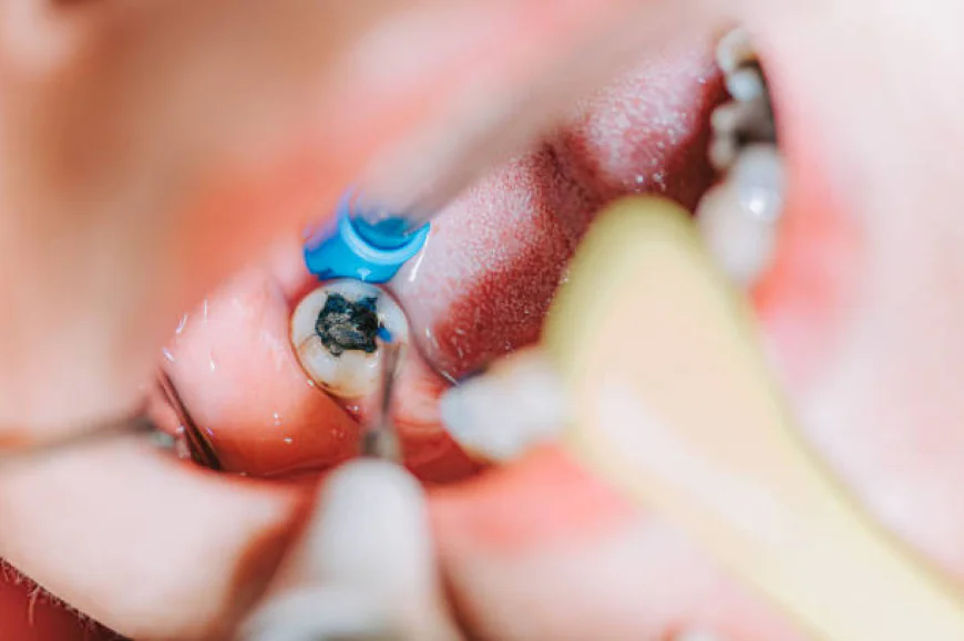 Dental Filling in Pakistan – Restore Your Smile with Modern Dentistry