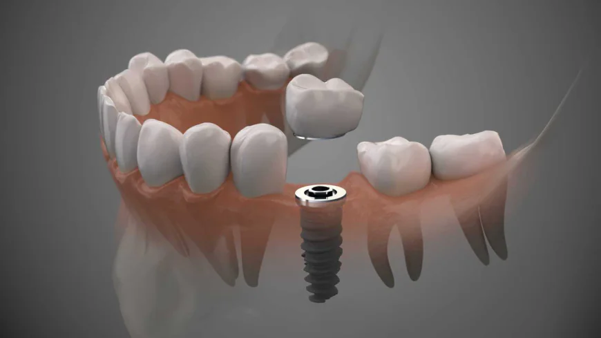Dental Implant Cost In Dubai: Full Price Guide
