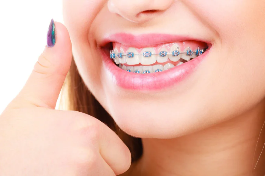 Get a Confident Smile with Expert Braces Treatment in Nadiad