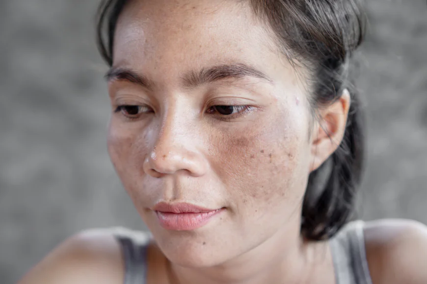 How Pigmentation Treatment Supports Skin Balance