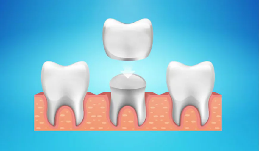 When Do You Really Need Dental Crowns in Simi Valley?