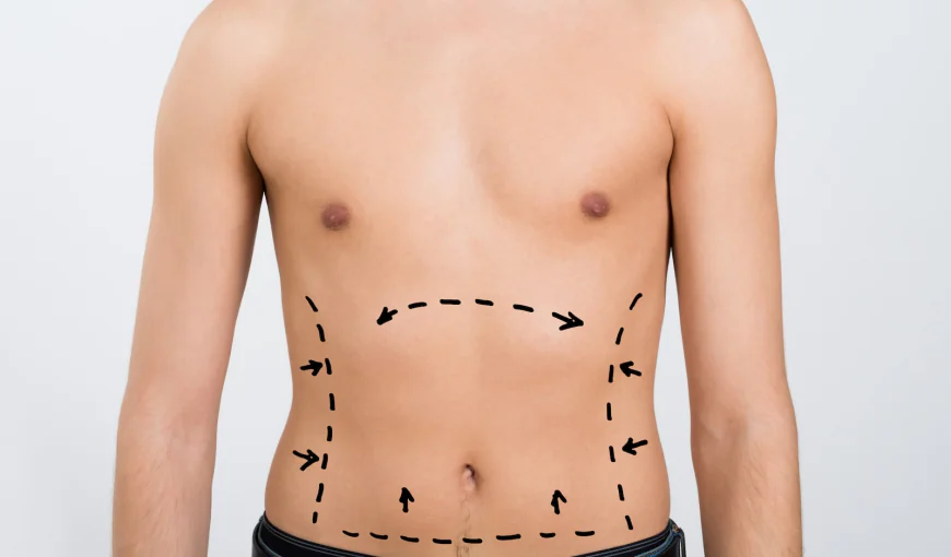 SmartLipo vs Laser Liposuction: Key Differences Explained