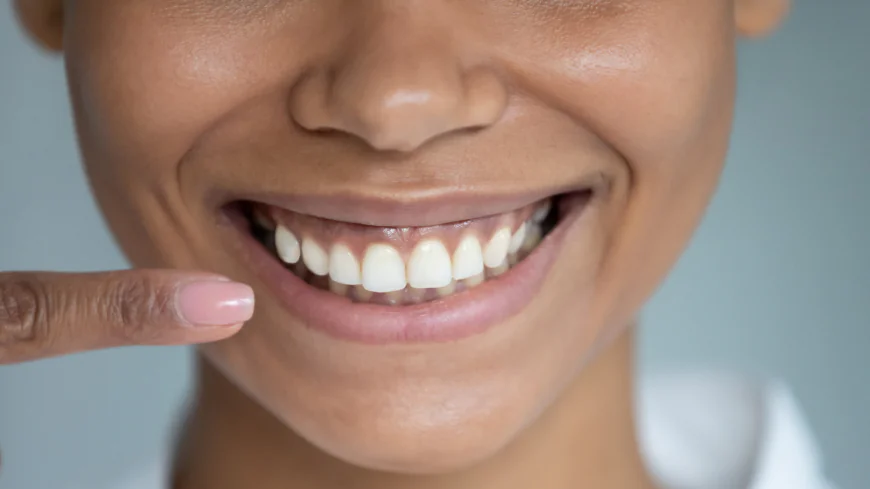 Teeth Whitening in Dubai: Your Guide to a Brighter Smile