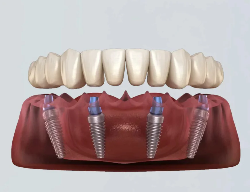 How Long Does All-on-4 Dental Implant Treatment Take?