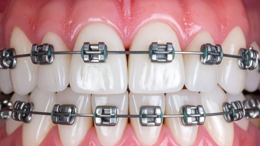 Dental Braces in Dubai for Perfect Teeth Alignment