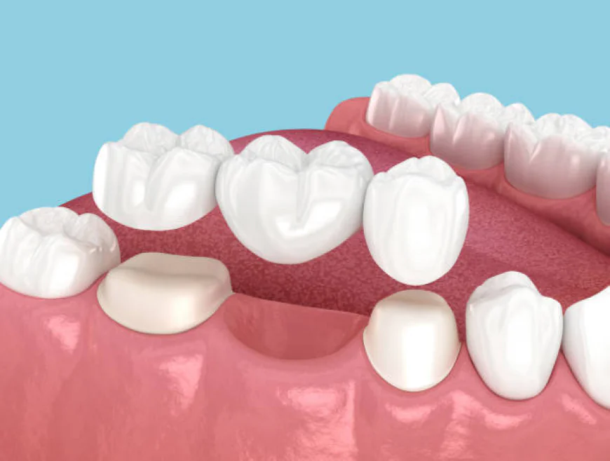 Root Canal Treatment in Pakistan – A Complete Guide for Patients